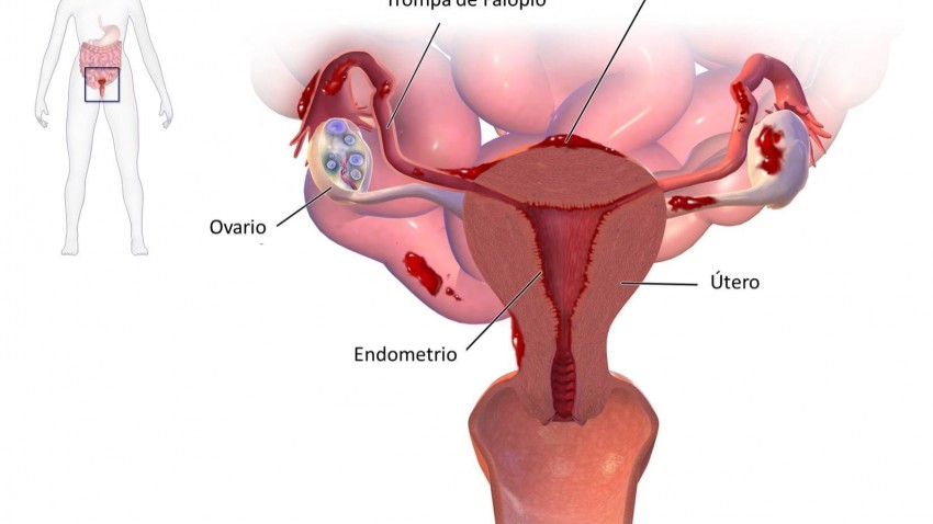 Endometriosis