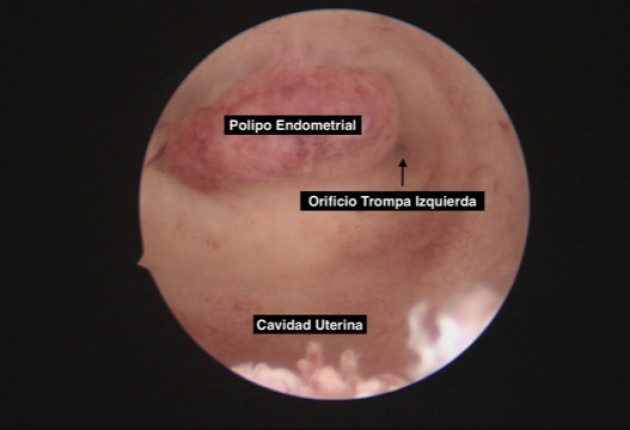 Histeroscopia